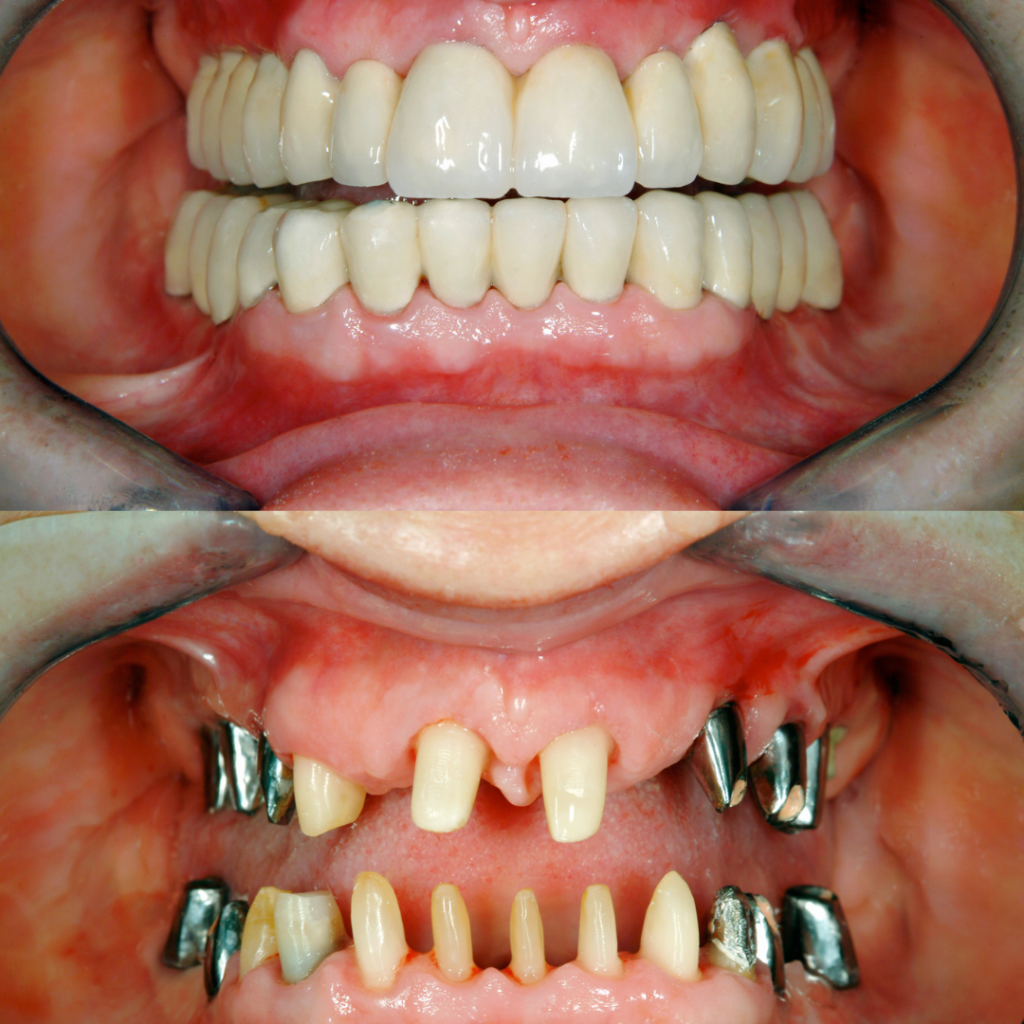 full mouth rehabilitation
