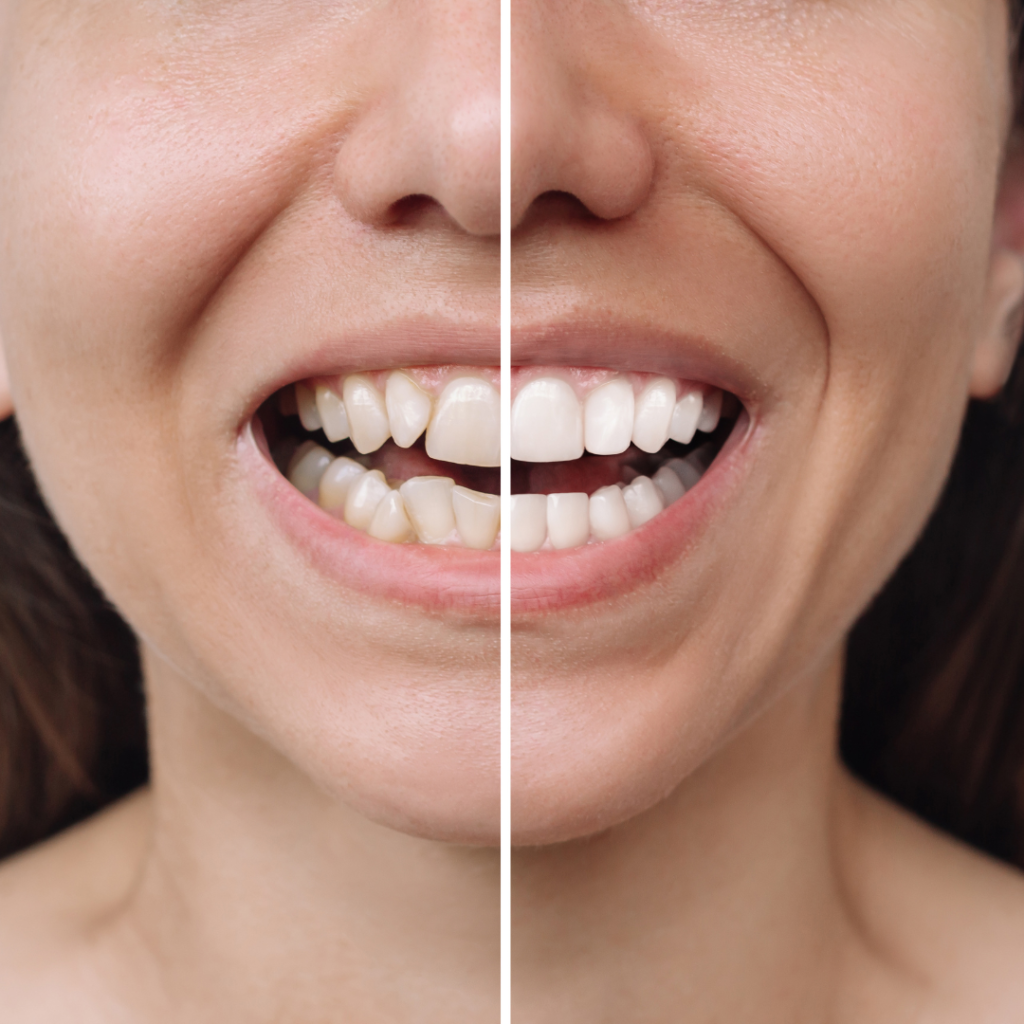 Veneers & Cosmetic Dentistry in Anna Nagar