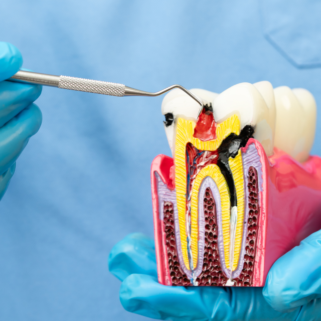 Root Canal Treatment in Anna Nagar Chennai