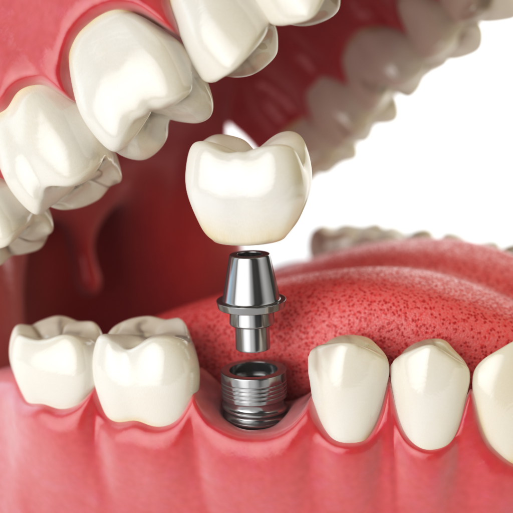 best dental implant in anna nagar
