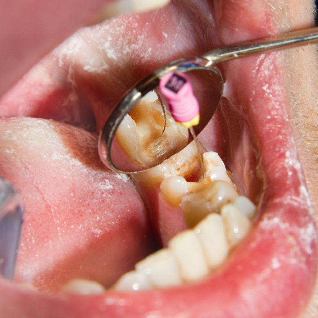 Root Canal Treatment in Anna Nagar Chennai