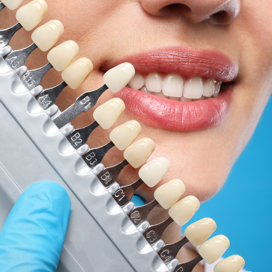 Veneers & Cosmetic Dentistry in Anna Nagar, Chennai