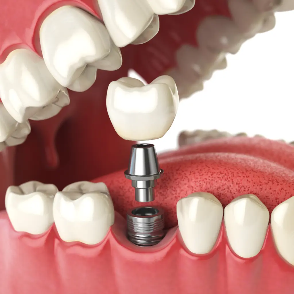 best dental implant in Anna Nagar