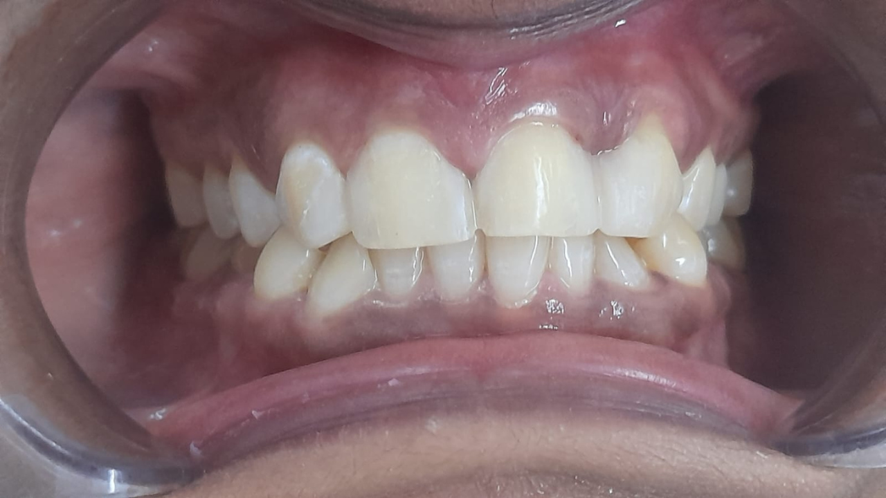 smile makeover