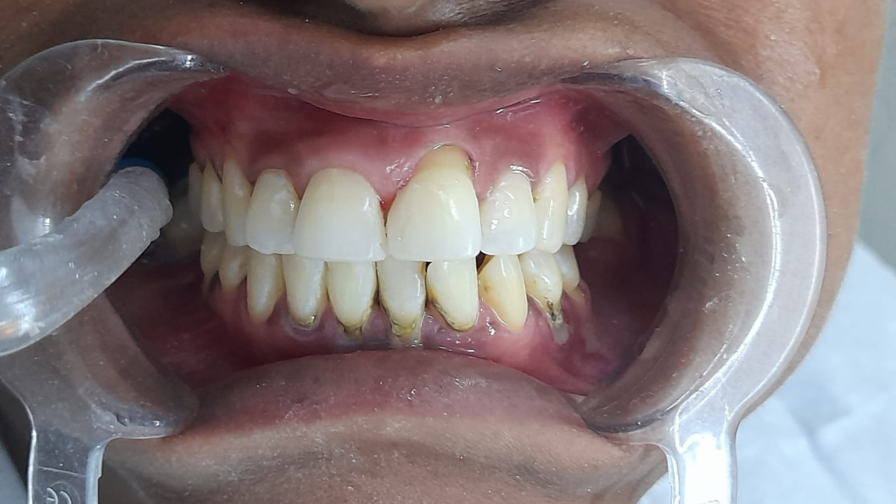smile makeover