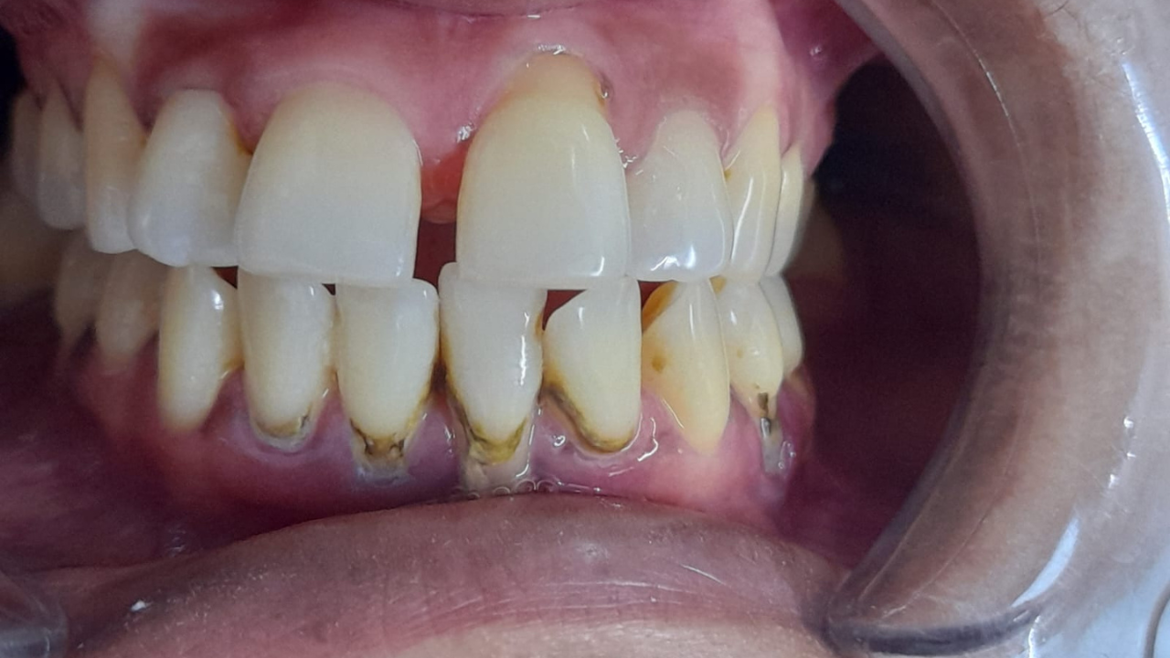 smile makeover