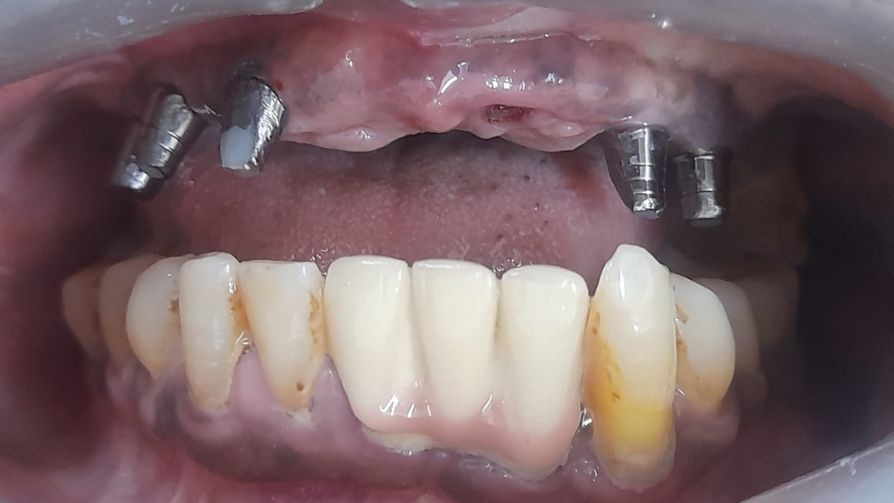 Dental Implants in Chennai