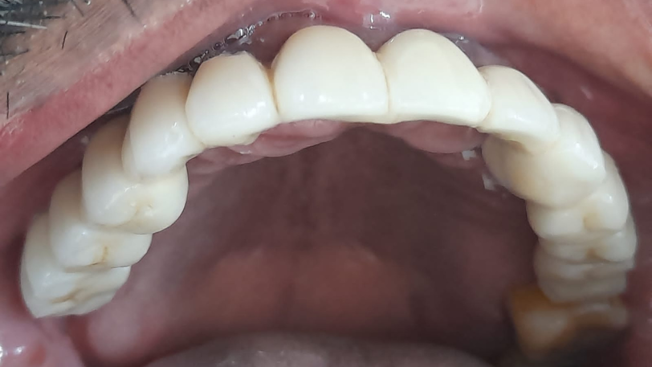 Dental Implants in Chennai