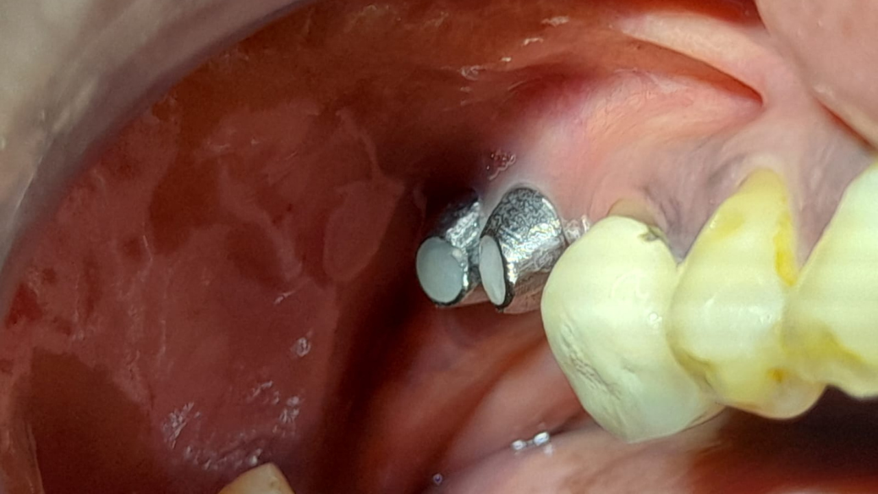 Dental Implants in Chennai