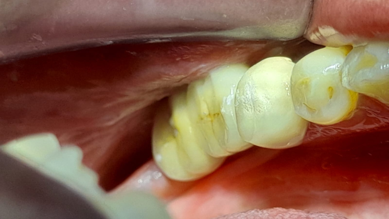 Dental Implants in Chennai