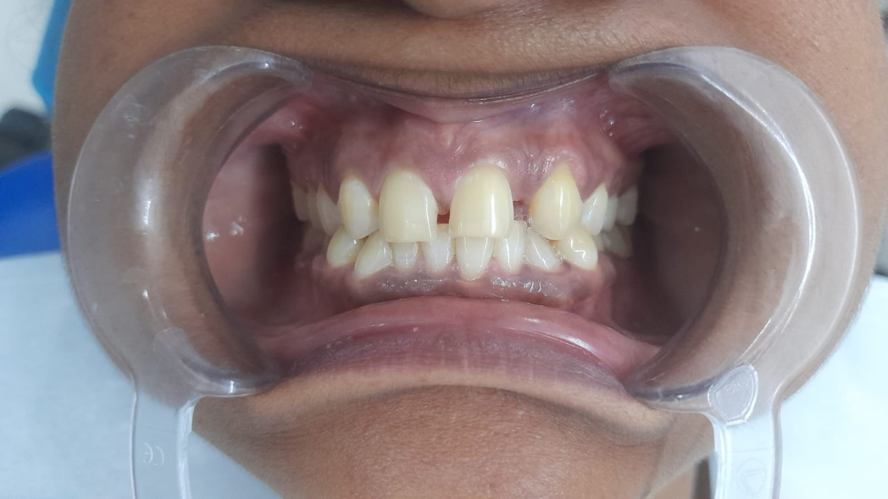 smile makeover