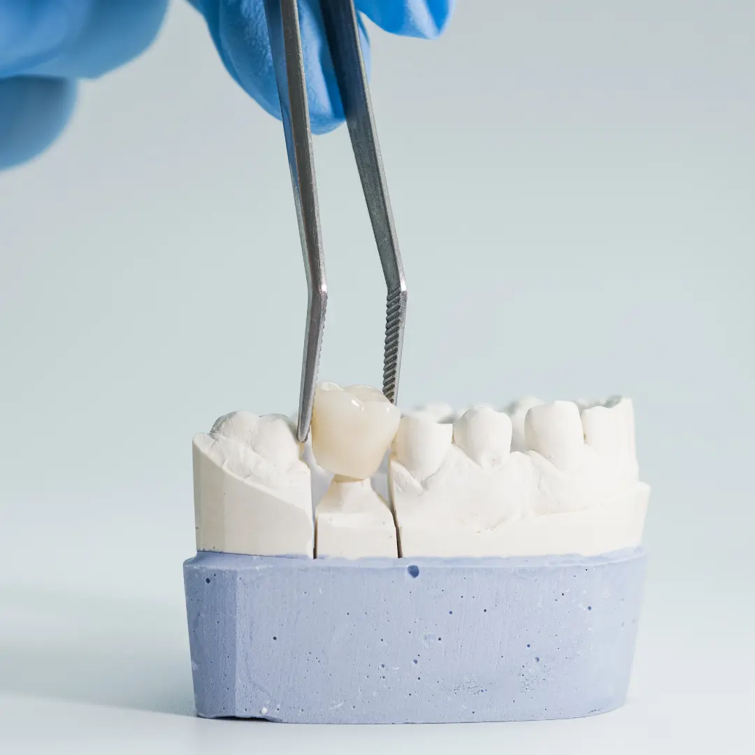 Dental Crowns & Bridges in Anna Nagar, Chennai